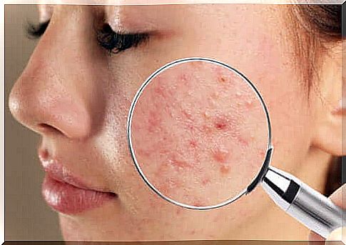 Juvenile acne: types and causes