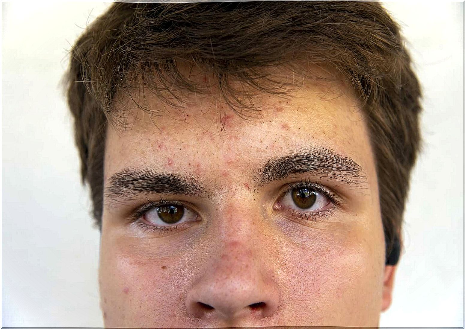 juvenile acne