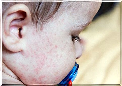 Skin irritations in babies: what to do?