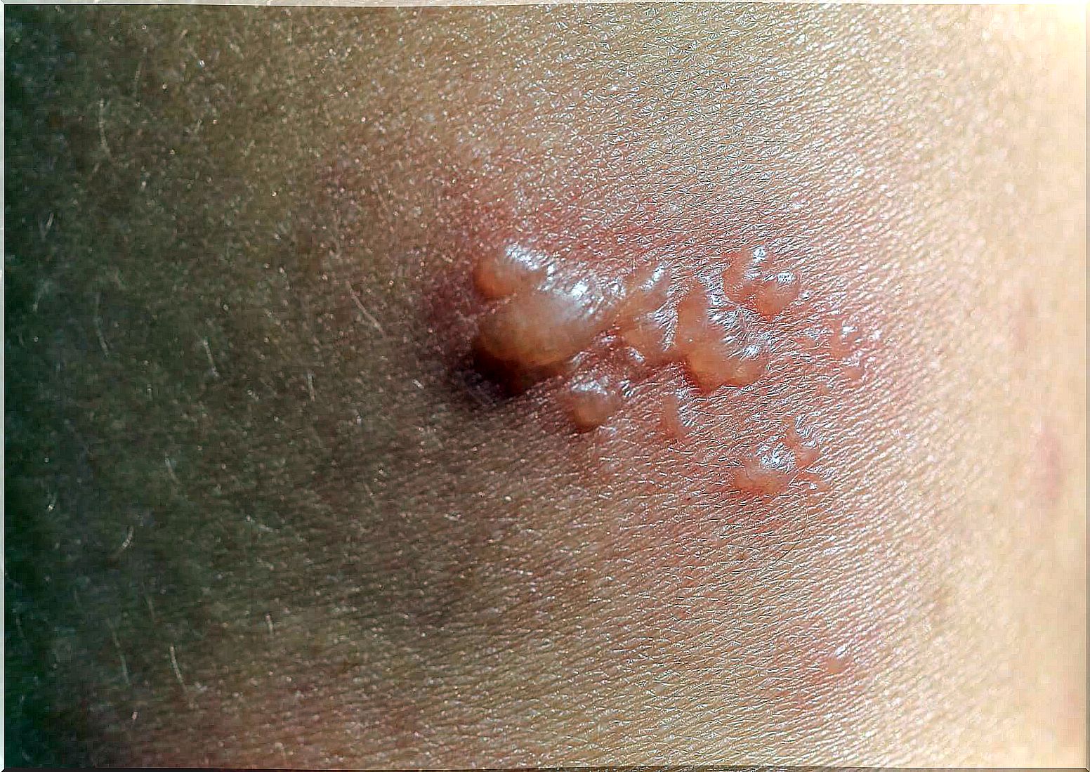 gestational pemphigoid